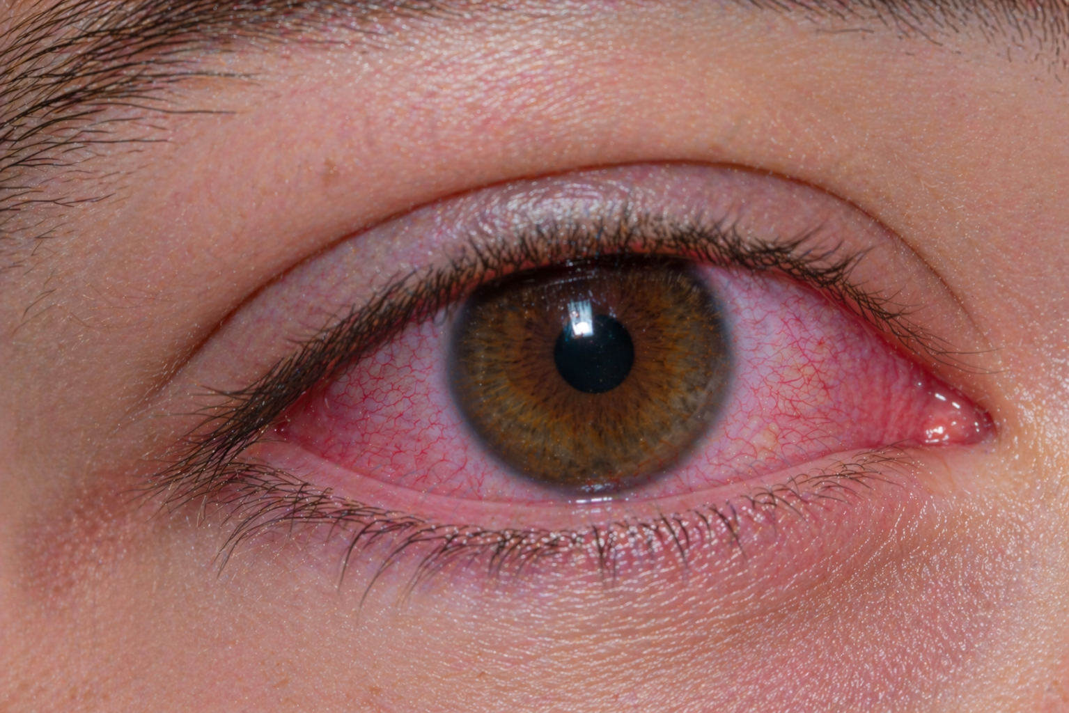 Conjuntivite viral olho vermelho com lacrimejo