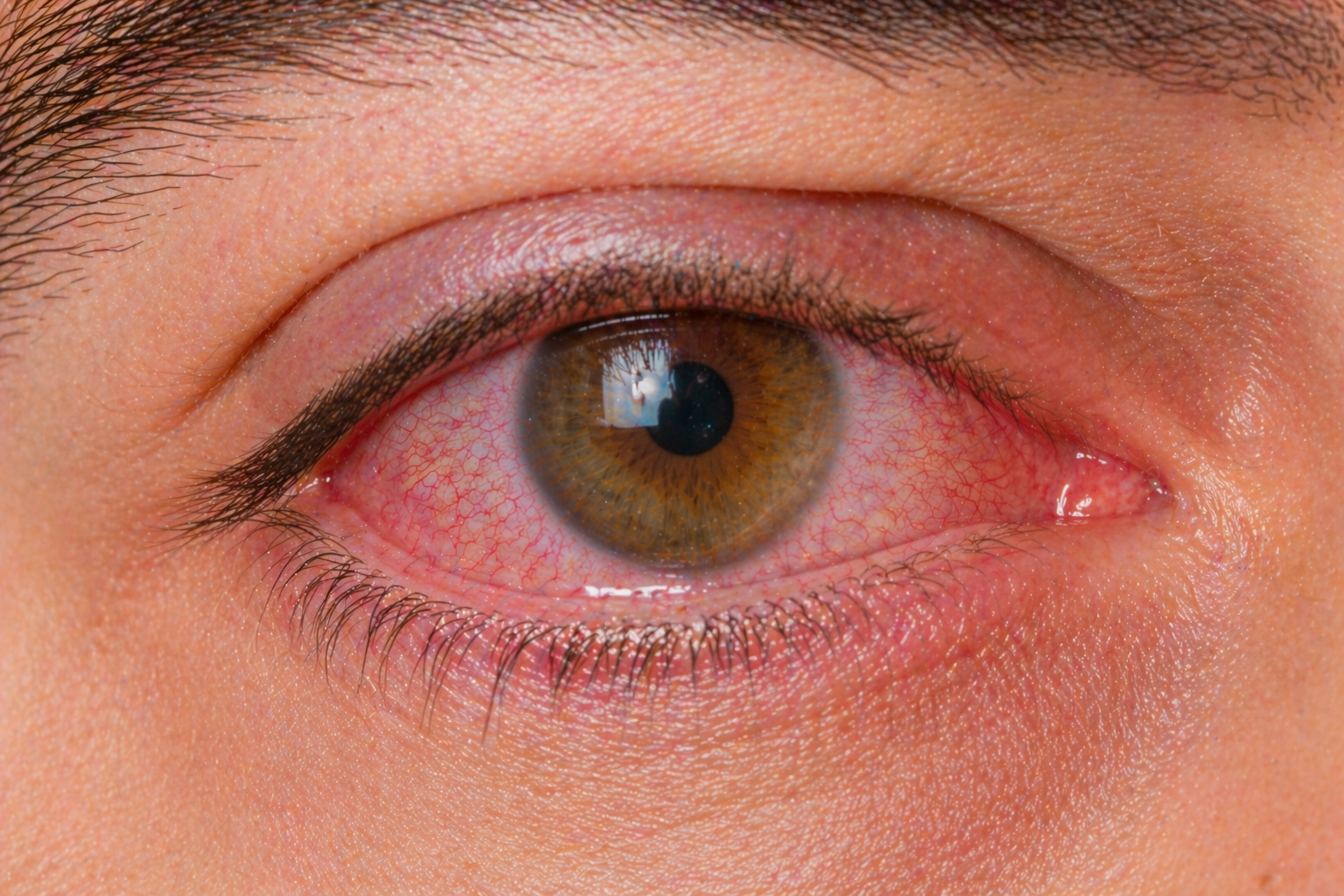 Conjuntivite alérgica com olhos vermelhos e comichão