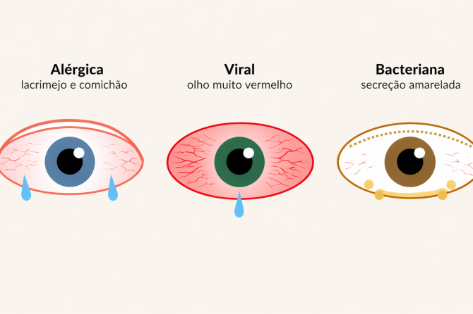 Tipos de Conjuntivite: Alérgica, Viral ou Bacteriana (Guia Completo)