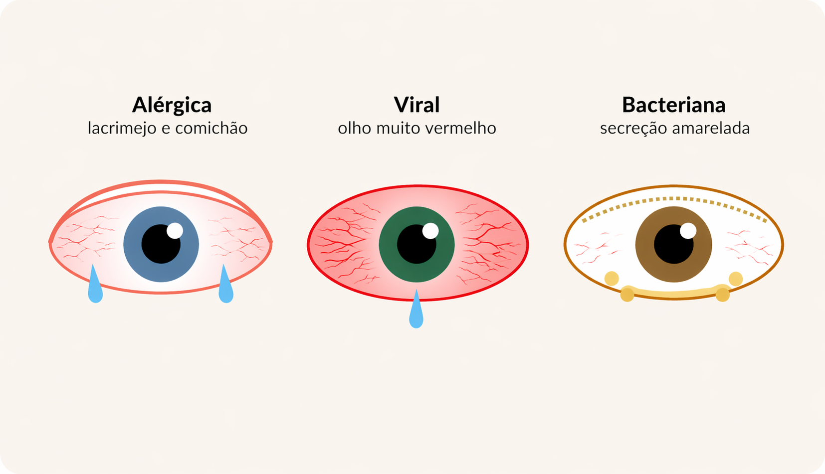 Tipos de Conjuntivite: alérgica, viral e bacteriana